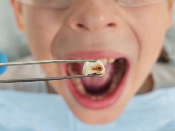 Best Emergency Tooth Extraction in Eau Claire, WI